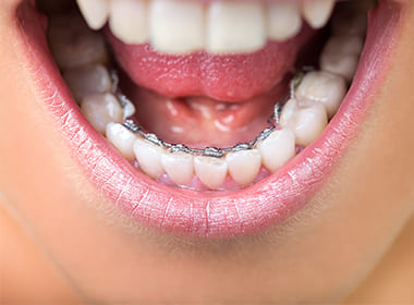 舌側矯正システム