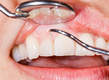 歯周病には早期のアプローチを行います