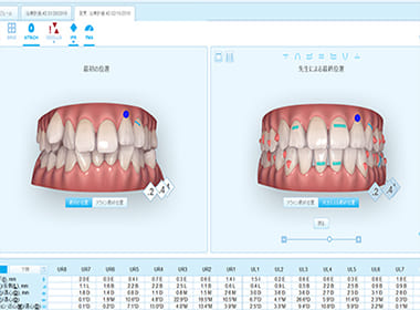 未来の歯並びが確認できるクリンチェック