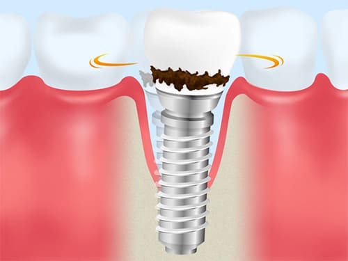 インプラント周囲炎とは？