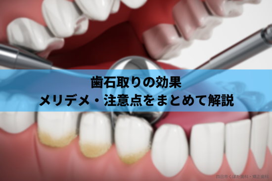 歯石取り（除去）の効果について｜メリットやデメリット、注意点もまとめて解説