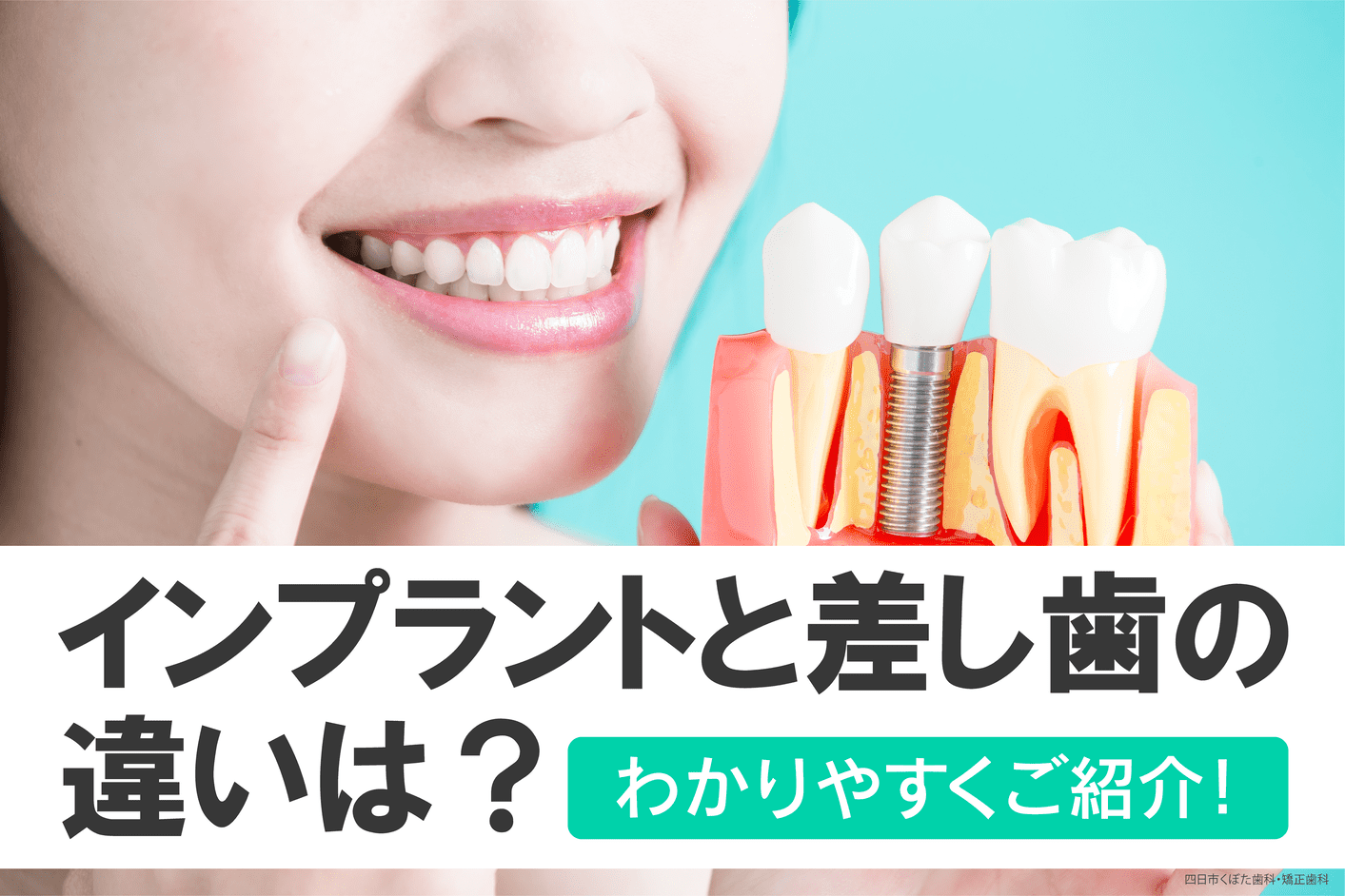 インプラントと差し歯の違いは？わかりやすくご紹介！