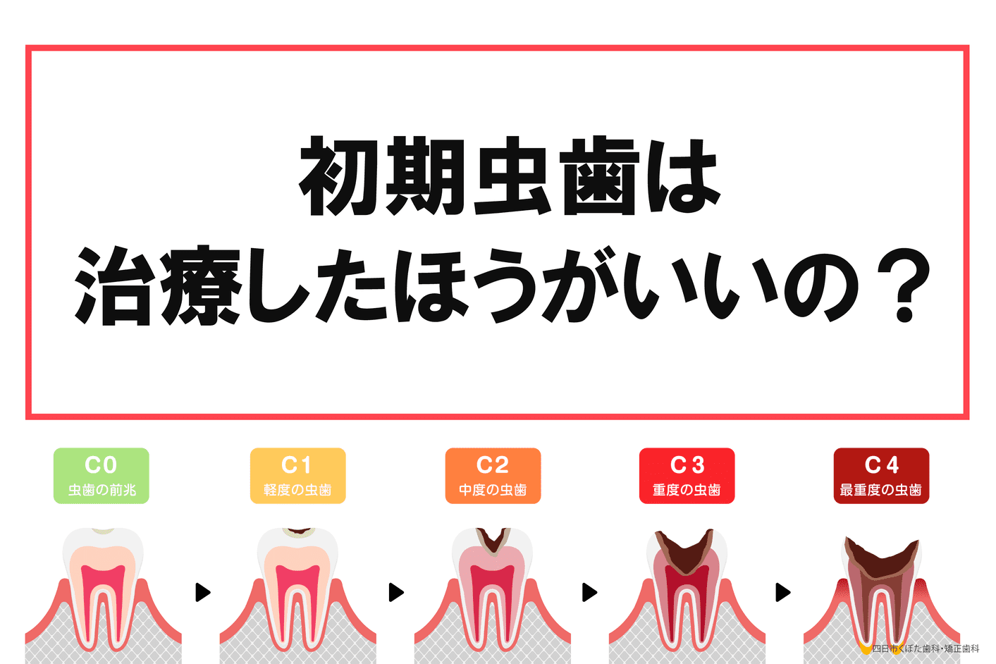 初期虫歯は治療したほうがいいの？