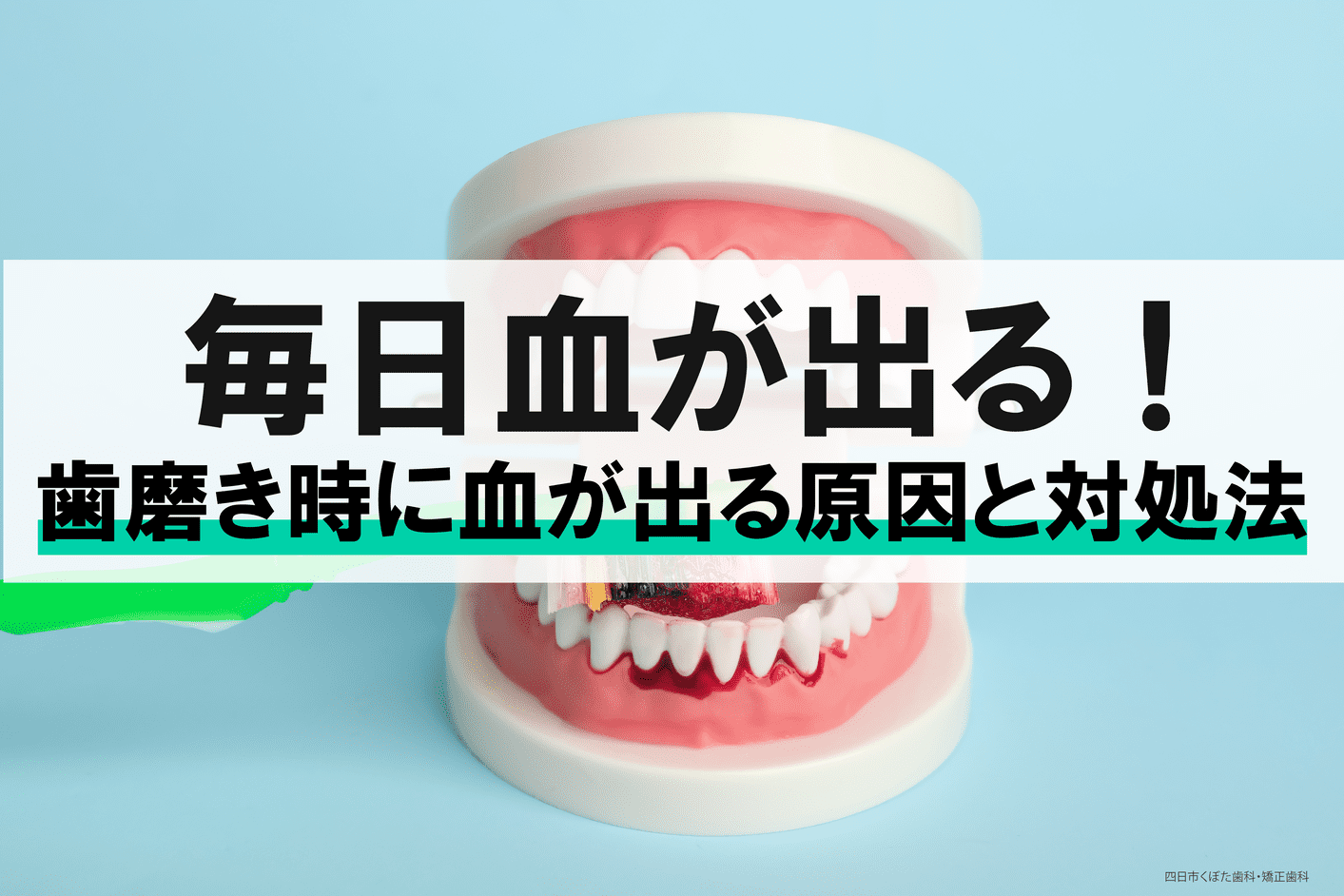 痛くないけど歯磨きをすると毎日血が出る！原因や対処法とは