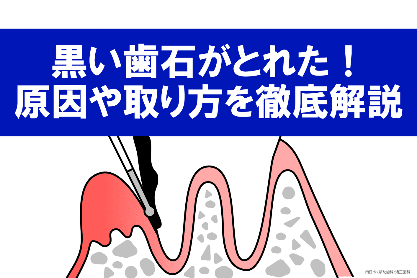 517虫歯じゃないのに奥歯が痛い原因は？対処法を徹底解説