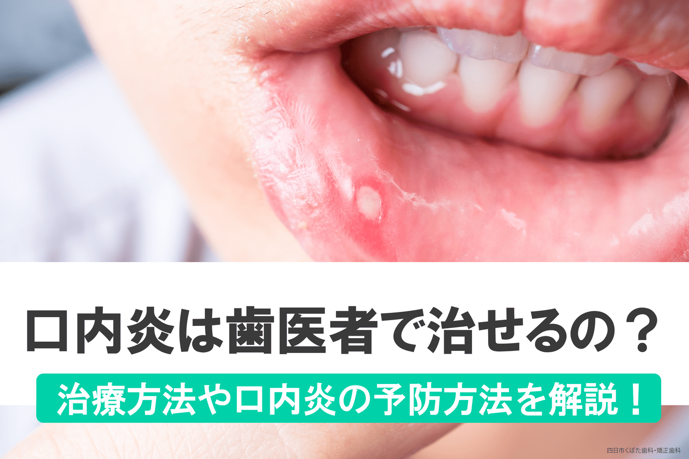 709歯並びを治したい！でもお金がない！そんなときにおすすめの方法とは？