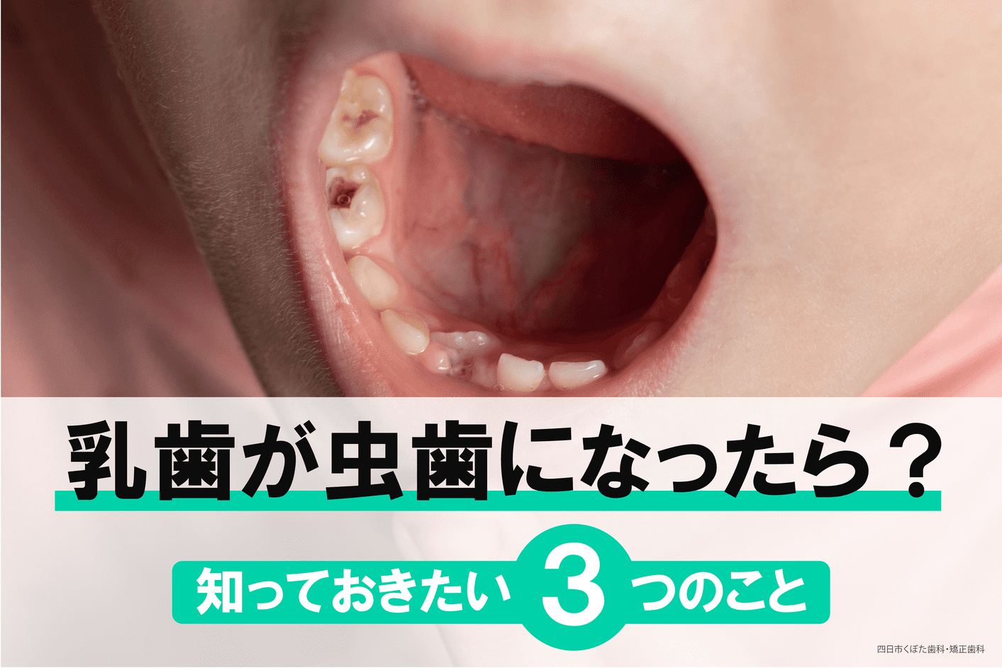 712口内炎は歯医者さんで治せるの？予防や治療について解説！